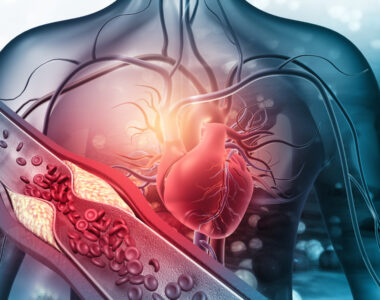Erhöhtes Risiko für Herz-Kreislauf-Erkrankungen bei Psoriasis-Arthritis