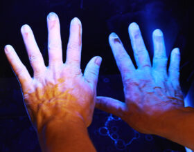 Wirksamkeit von Salzwasserbädern und künstlichem UV-Licht bei Psoriasis