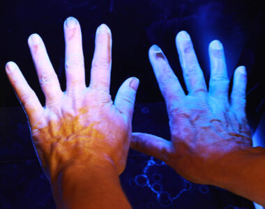 Wirksamkeit von Salzwasserbädern und künstlichem UV-Licht bei Psoriasis